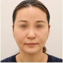 루르드성모의원 | 부산 서면 티타늄리프팅, 후기 보셔도 소용없는 이유