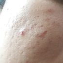 더나은한의원 | 피부과한의원 흉터치료 과정 방법 후기