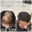 M헤어스타일 | [성주] 남자 탈모펌 전문 M자이마 정수리 탈모 해결한 후기, 어려보이는 헤어스타일 미용실추천