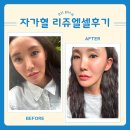 양실장피부관리실 | 강남 피부과에서 줄기세포 유도인자 자가혈 리쥬엘셀 받고 온 후기!