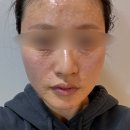 아이스킨 | [리쥬란] 스킨보톡스 리쥬란아이 효과 엠보 기간 수면마취 후기 강남