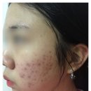 알라딘한의원 | 모낭염 한의원 추천 하기 전에 다녀본 피부과 후기도 공유해용