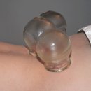 Cupping 이미지