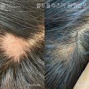 콜드플라즈마 이미지