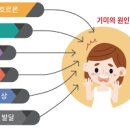 기미 없애는법 기미약 트라넥삼산 히드로퀴논 아젤라산 이미지