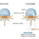 허리디스크 통증 알아봐요 이미지