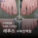 레푸스 수락산역점 | 레푸스 수락산역점 | 가운데 움푹 파진 발톱 스케일링 후기! 도봉구 무좀/내성발톱 전문 레푸스