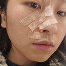 더메이피부과의원 | 용인 메이퓨어 피부과 편평사마귀 제거 후기