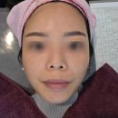 여드름흉터 홍대 한의원 홍대 화침 시술 2회차 후기