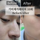 평촌 기미잡티제거 10회 후기/befor&amp;after 엔디야그 레이저