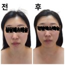 신대한엘피지제1 | [안동옥동] 청담에스테숲 써마웨이브 "턱날려" 솔직 후기, 처진 얼굴선과 피부 탄력 관리