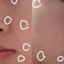 압구정에이블의원 | 진월동 압구정 에이블 피부과 후기 - 점 빼기