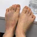 태초한의원 | 🔥주의🔥내내 발 사진만 나옵니다. 남의 발 보기싫은 사람은 클릭하지 마시오.