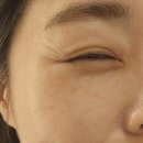 광주 첨단 피부과 쥬네르의원에서 보톡스 맞고 왔어요!!