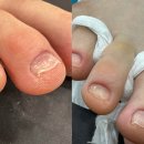 네일하기 | 압구정 문제성 발톱 전문 이홍진네일 여름 패디 네일 하기 전 파라젤 관리 후기