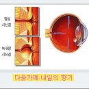 녹내장의 원인과 증상 이미지