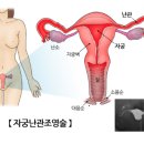 Ray_o | 나팔관조영술 (초음파) 후기 &amp; x-ray 비교