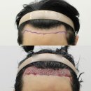대전 헤어라인 모발이식 내돈내산 후기 (비절개 수술, 수술전후, 샴푸, 주의사항)