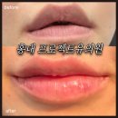 프로젝트유 | [홍대] 프로젝트유의원｜자연스러운 입술필러｜ 전후사진｜붓기, 통증 등 내돈내산 시술 찐후기