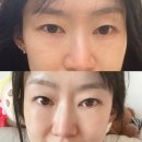 튠업 | 청담피부과 아이튠업 눈가리프팅 받은 솔직후기