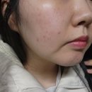 알파안전 | 청담동피부과 울트라펄스알파 여드름흉터치료 첫 진료 후기