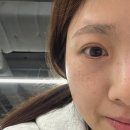 참좋은피부과의원 | 구디피부과 밴스의원 피코토닝 1회차 효과