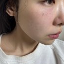 청량리30 | 청량리역 피부과 레티젠 후기, 30대 피부관리 추천