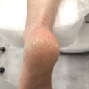 화성 발각질, 관리 후기 레푸스동탄반송점 깔끔한 관리