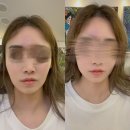 대구 서울바른피부과 볼필러 내돈내산 솔직후기