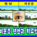 ★ 비문증 원인과 치료법 ★ 이미지