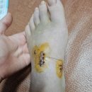 발등 리스프랑 인대 파열 및 골절 수술 후기 7 슬기로운 집안 생활