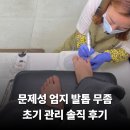 전주 효자동 발톱무좀 초기 증상 관리 후기 문제성 전문 홀드핀칭 네일제작소