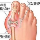 통풍 원인증상치료예방 : 근육질 남성에게 자주 찾아오는 통풍발가락 붓기 이미지