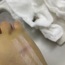 GS25 광주병원점 | 🏥 광주대중병원 입원 우측 중수부 골절수술 및 퇴원 후기