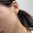 보람메트로피부과의원 | 신사역 리프톤피부과 리쥬란 3회 내돈내산 솔직후기 (시술사진ㅇ)