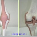 사상체질 - 사상체질로 본 다양한 무릎관절통의 원인 이미지