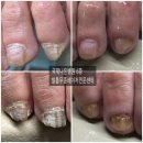 서울나은병원 | 안양 발톱무좀/안양 내성발톱/안양 무좀/안양 국제 나은 병원 방문 만족 후기