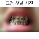 앞니6개 지르코니아 심미보철 한 후기 이미지