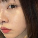유어힐의원 리쥬란+물광주사 일주일 후기
