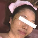 [대구북구피부관리] 여드름 피부에 좋은 약초필링 ‘정명순내면미용’ 후기
