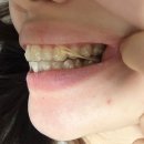 미소메디텍 | 인비절라인 과개교합 교정 고무줄 시작 30대 직장인 4개월 후기