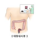 ※대장암에 대한 정의와 상식※ 이미지