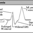 Hyperkalemia 이미지