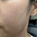 루비로 | 전주 루비레이저 기미,주근깨 제거 솔직 후기