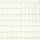 LBBB &amp; supraventricular tachycardia 이미지