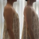 장동로19번길L | 예비신부 팔뚝라인 정리 후기 | 광주 수완지구 웨딩관리 365 메디스킨