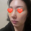 요가비주 | 무보형물 코성형 코수술 후 한달차 솔직후기