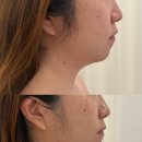 사계에스테틱 | 부산 이중턱관리 사계에스테틱 전후 차이 확실한 후기
