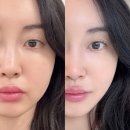 600 | 강남피부과 울쎄라600샷 후기 얼굴라인 변화 효과 통증까지 총정리