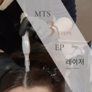 탈모치료 선릉역피부과 정수리탈모 넓은 이마 탈모관리 솔직후기
